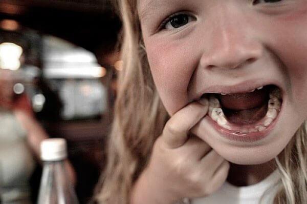 Как вовремя распознать кариес на молочных зубах?